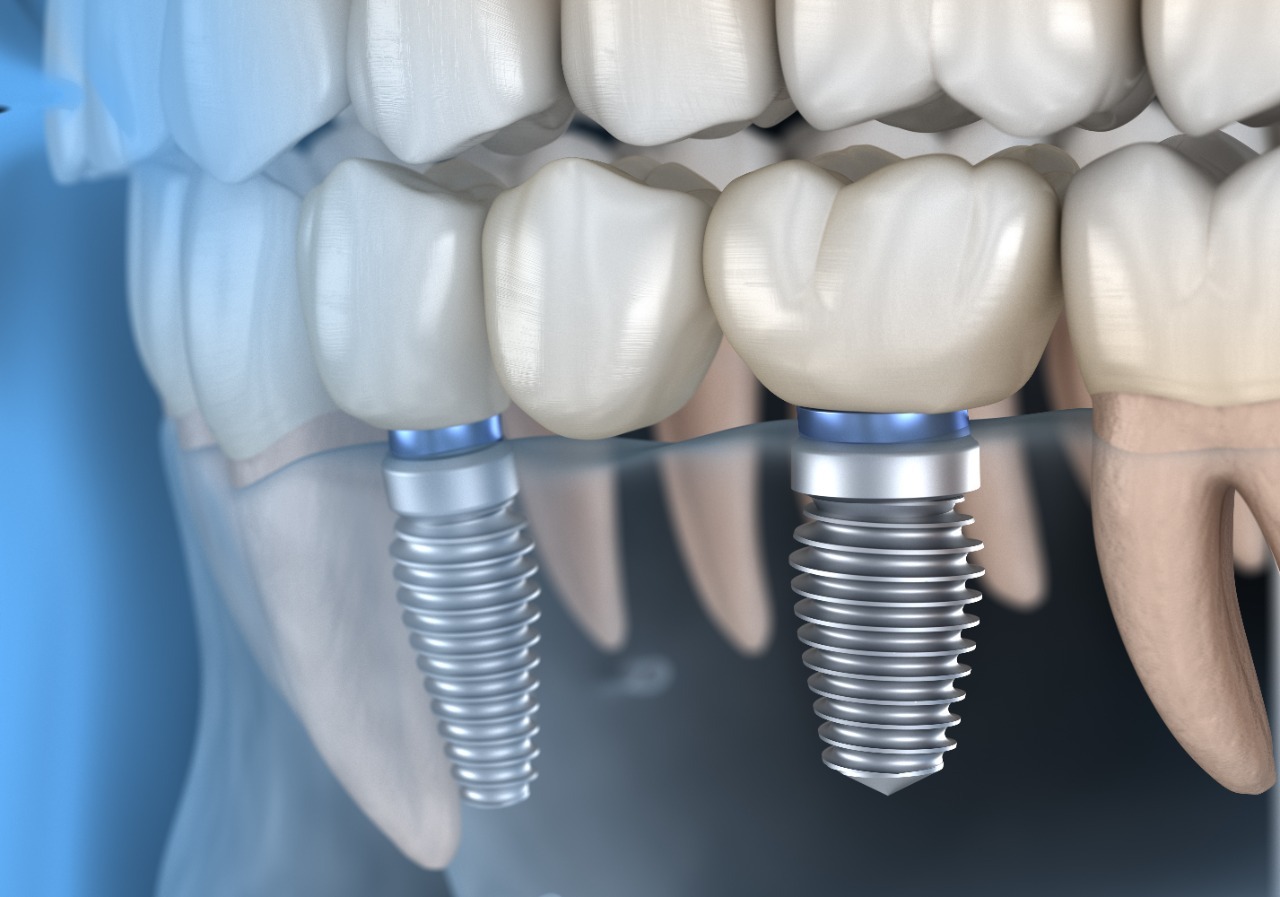 Implante Dentário em Ouro Preto BH - Tratare Odontologia