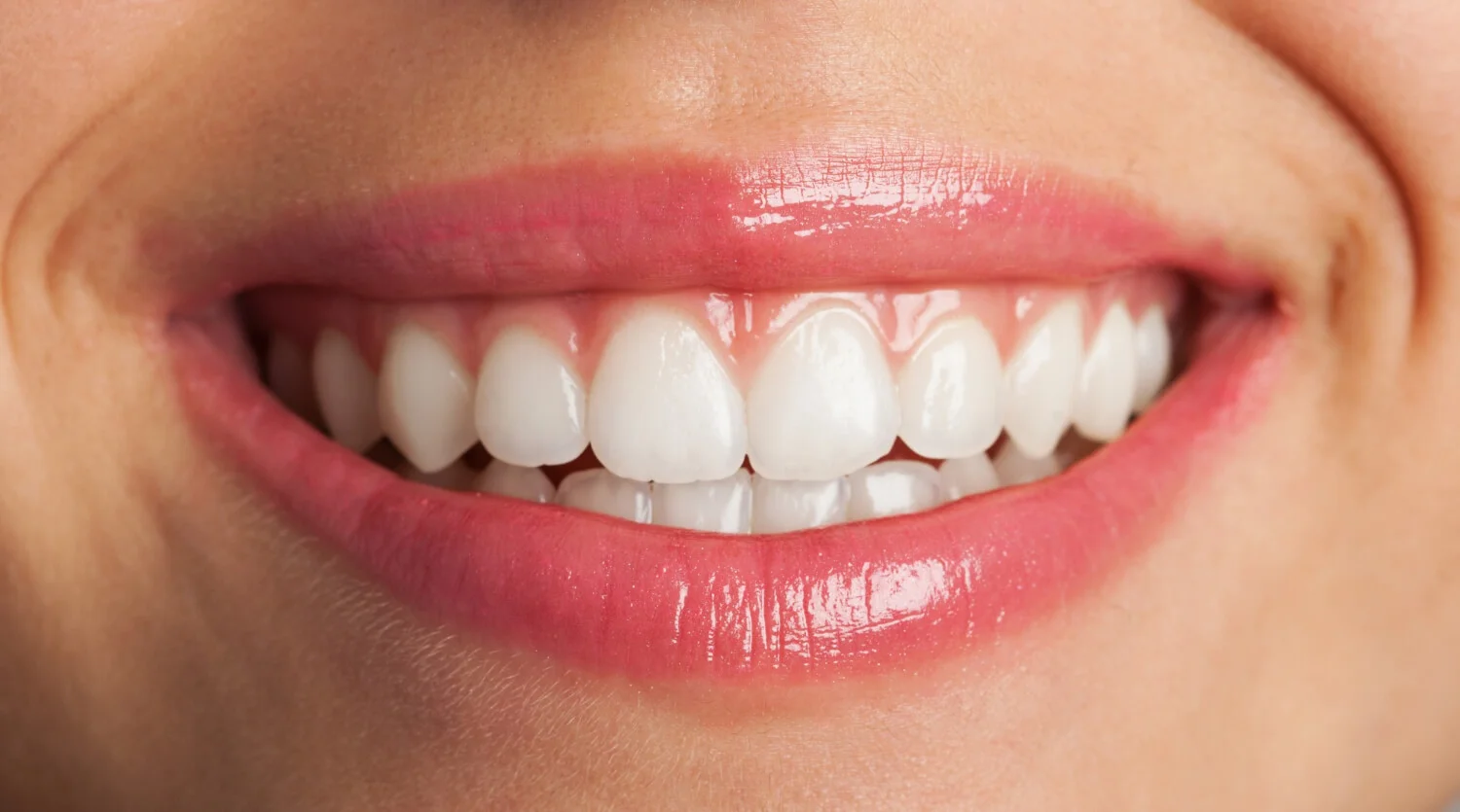 Facetas em Resina em Ouro Preto BH - Tratare Odontologia