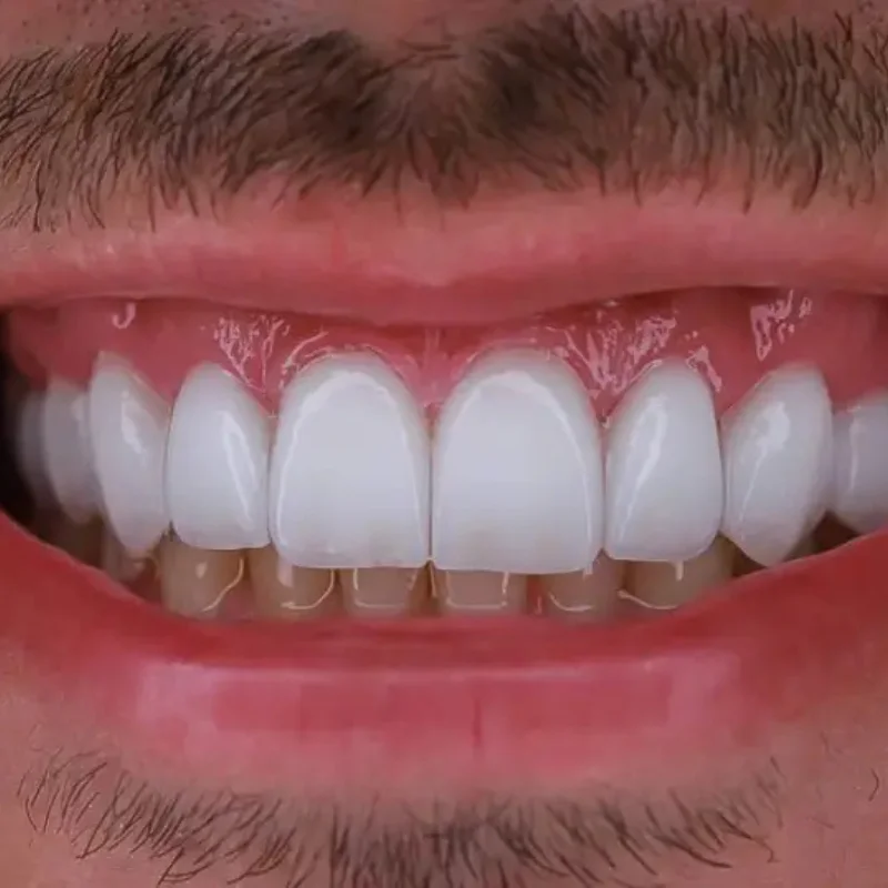 Facetas em Porcelana em Ouro Preto BH - Tratare Odontologia