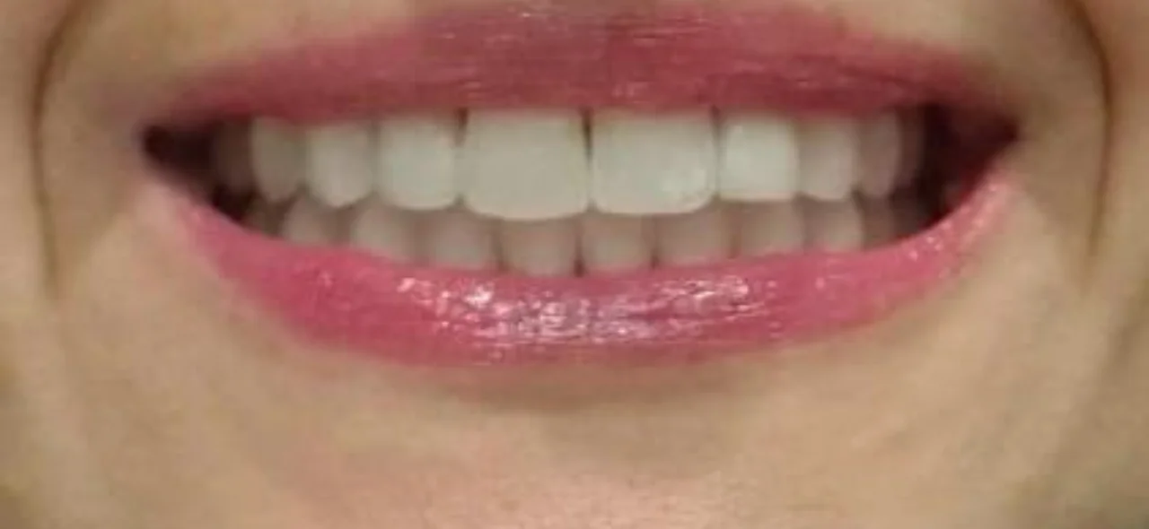 Depois: Invisalign