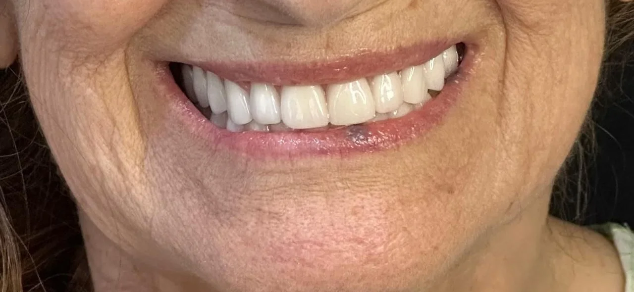 Prótese Dentária em Ouro Preto BH - Tratare Odontologia